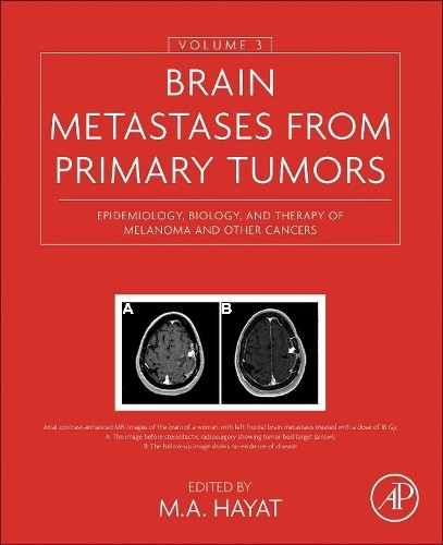 M. A. Hayat Brain Metastases from Primary Tumors, Volume (Hardback) (UK IMPORT)