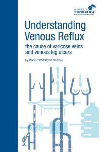 Understanding Venous Reflux The Cause of Varicose Veins and Venous Leg Ulcers…
