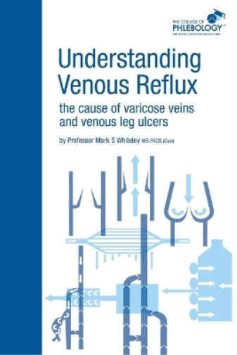 Mark S. Whitele Understanding Venous Reflux the Cause of Varicose Ve (Paperback)