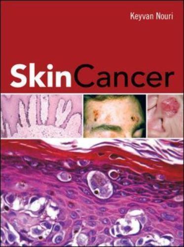 Skin Cancer by