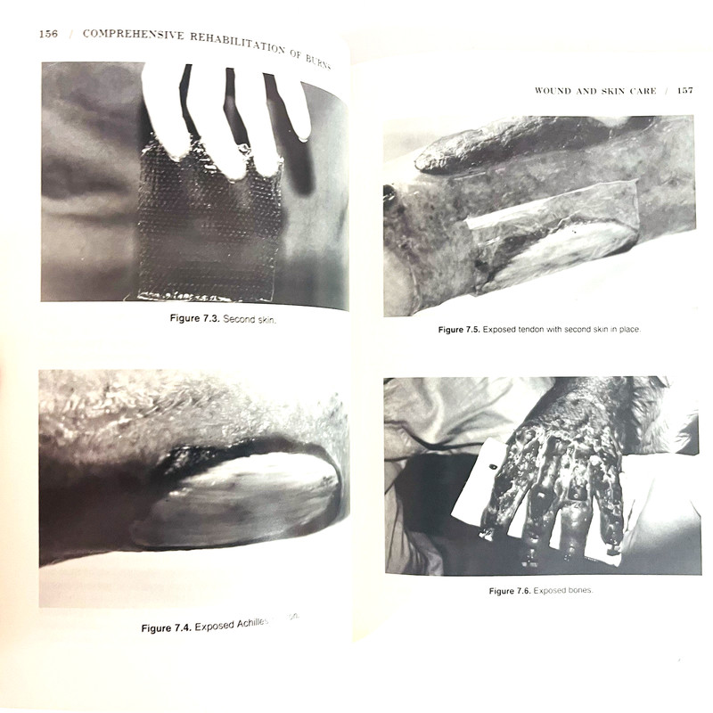 Vintage Comprehensive Rehabilitation of Burns Book Hardcover RML 1984 gallery